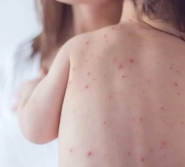 São Paulo registra segundo caso de sarampo em 2025