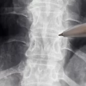 Anvisa libera estudo com medicamento para lesões na medula espinhal