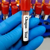 Brasil segue líder mundial em mortes por Chagas, apesar da queda de casos e óbitos