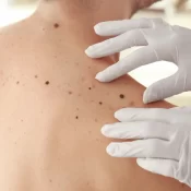 Casos de câncer de pele saltam de 4 mil para mais de 72 mil em 10 anos