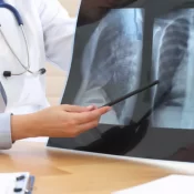 Estado de São Paulo vive boom de pneumonia e casos quase triplicam em três anos