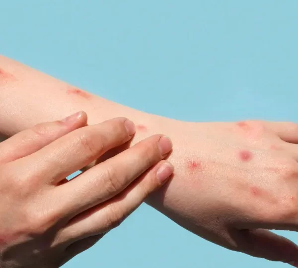 Brasil registra 48 casos de mpox nos primeiros meses de 2026