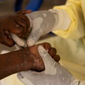 Brasil registra 88 casos de Mpox em 2026; saiba como evitar a doença