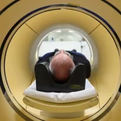 Alzheimer é a segunda doença mais temida pelos brasileiros, atrás apenas do câncer