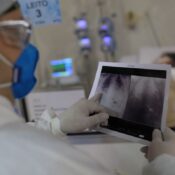 Broncopneumonia: entenda quadro que causou internação de Bolsonaro