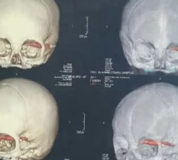 Cientistas acham crânios de 2.000 anos, e detalhe nos dentes chama atenção