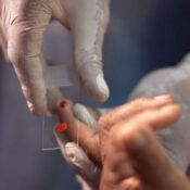 SUS começa a usar novo tratamento contra a malária em crianças