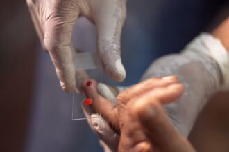 SUS começa a usar novo tratamento contra a malária em crianças