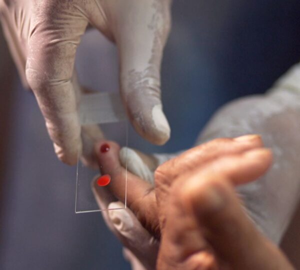 SUS começa a usar novo tratamento contra a malária em crianças