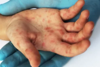 Ministério da Saúde confirma caso de sarampo no Rio de Janeiro