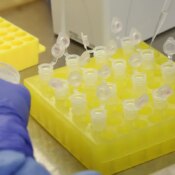 SP confirma segundo caso importado de sarampo